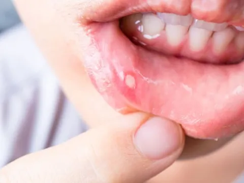 Phải chăng trời nắng nóng xảy ra hiện tượng nhiệt miệng?